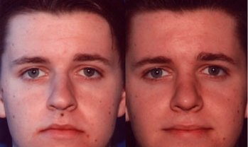 Before and after using dermatend cream