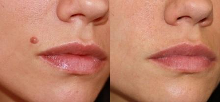 Mole removal before and after laser treament