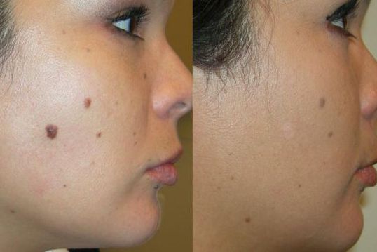 Mole removal with honey before and after