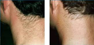 Before and after laser hair removal from back of neck