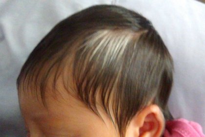 White birth marks on hair